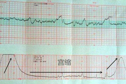 胎心监护宫缩40正常吗