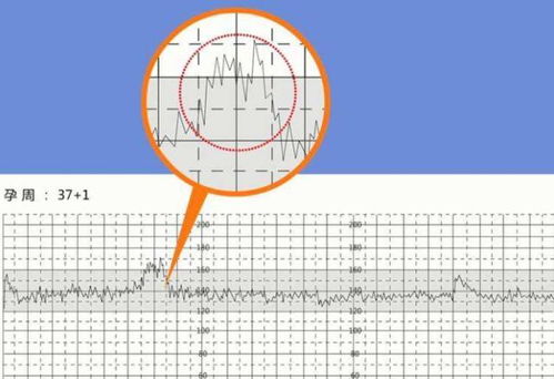 胎心监护宫缩40正常吗