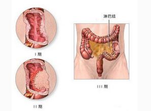 葡萄胎复发有什么症状是怀孕复发吗