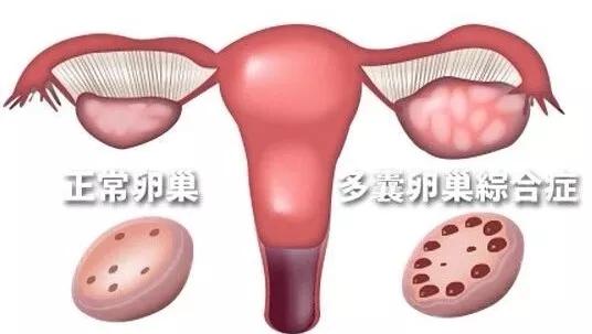 做宫腔镜后多久可以怀孕