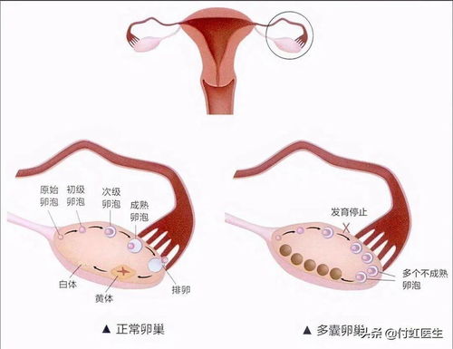 阴超显示多囊是怀孕了吗