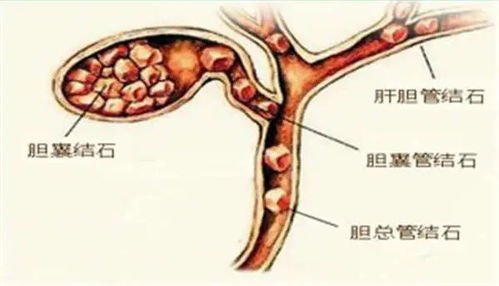 检测宫外孕的几个常用方法是