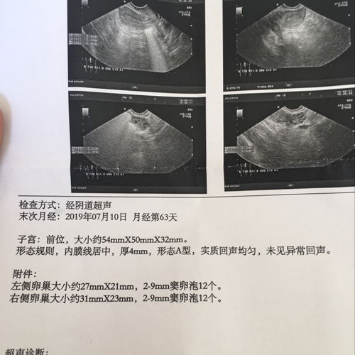 这个孕囊是长型还是圆型呢