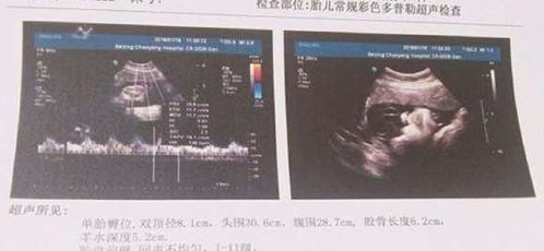 不孕做b超检查需要注意什么