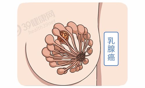 乳晕上有小疙瘩