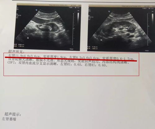 卵泡萎缩b超会显示什么