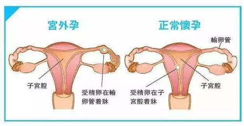 是什么原因会导致宫外孕呢