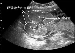 肾盂分离0.9cm会怎么样