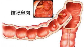 不孕与黄体酮的关系