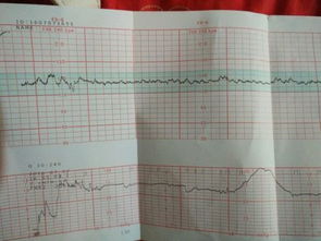 做胎心监护老是过不了，怎么办