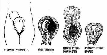 孕妇球拍状胎盘对胎儿有什么影响