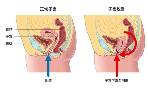 我生完孩子马上一年了，前两天刚又打掉一个孩子，现在做盆底修复效果会好吗？盆底修复是怎样做的？