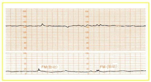 胎心监护图线是平的没有什么波浪