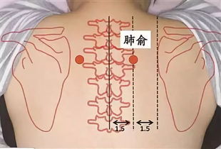 三伏天可以刮痧吗?