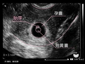 怀孕44天有孕囊未见胎芽