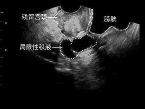 少量盆腔积液会影响怀孕吗