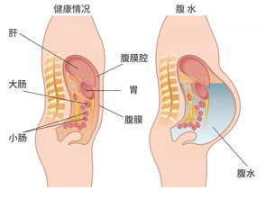 取卵后腹水几天最严重