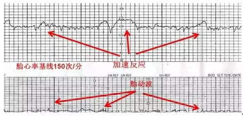 胎心率低于140是男孩吗