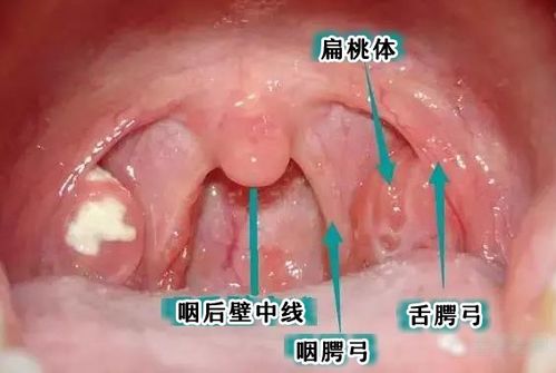 上颚薄膜掉了怎么办