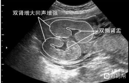 31周胎儿左肾盂分离12mm