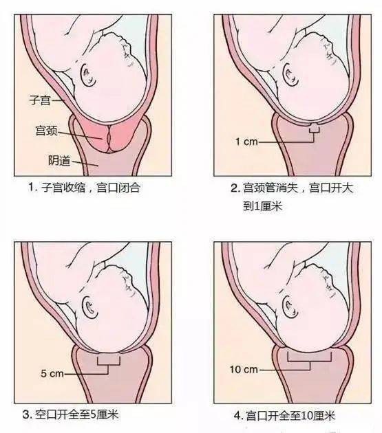 足月破水了没宫缩能顺产吗