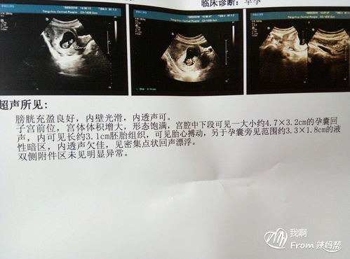 看孕囊数据大小能看出男女吗