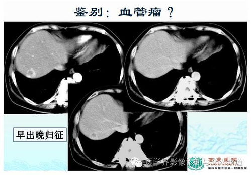 卵巢囊肿 是否是恶性