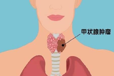 甲状腺癌 妊娠