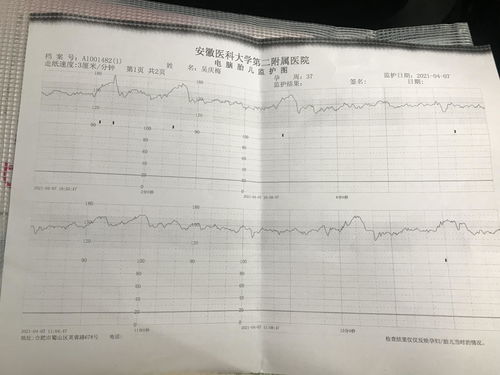 正常的胎心监护曲线图怎么看