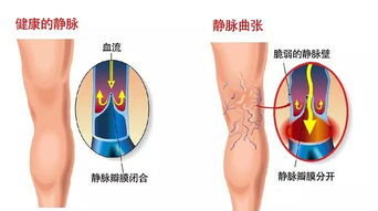 孕妇击退静脉曲张有8个妙招吗