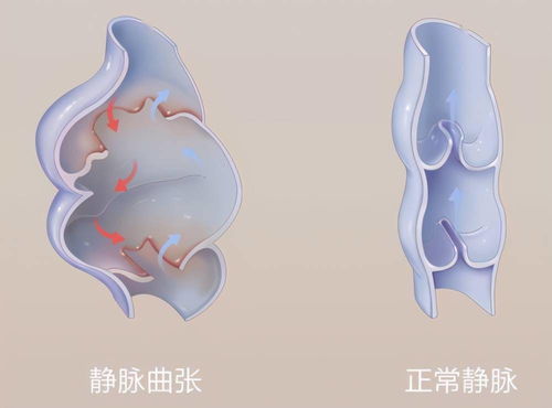 孕妇击退静脉曲张有8个妙招吗