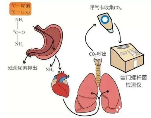 有幽门螺旋杆菌的人可以喝酸奶吗