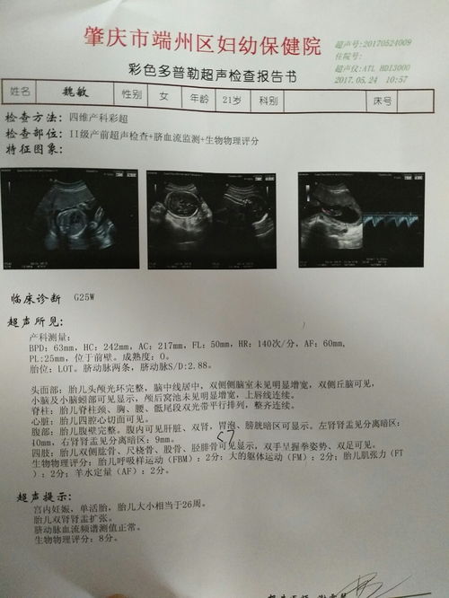 胎儿双肾盂分离