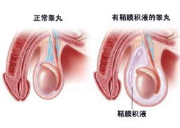 睾丸扭转怎么检查