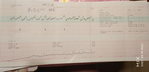 怀孕37周了，检查胎心率不及格是5分,怎么回事?