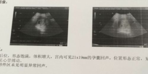 怀孕9周胚芽多大正常呢