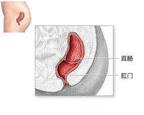 轻度直肠前突和直肠粘膜内脱垂