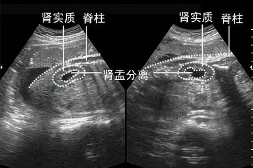 胎儿肾盂分离不能吃什么食物