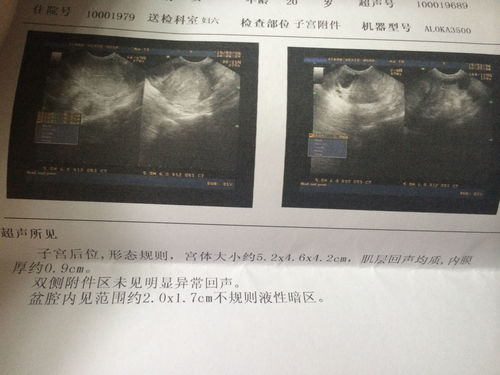 tct检查有轻度炎症是什么意思