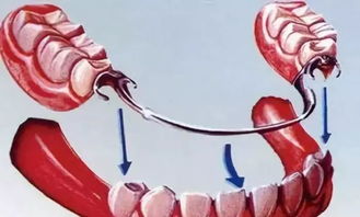 关于可摘局部义齿的问题