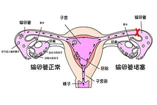 只剩一侧输卵管该怎么备孕