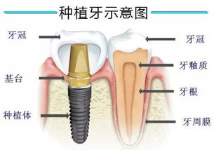 更换固定义齿