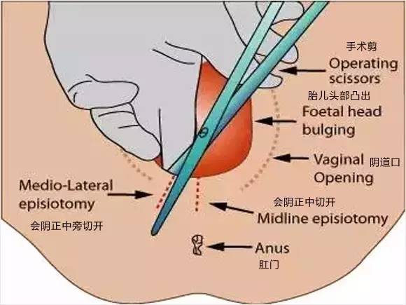 什么情况才会侧切