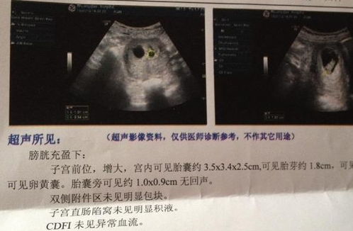 孕囊形状是长形的还是圆形的？