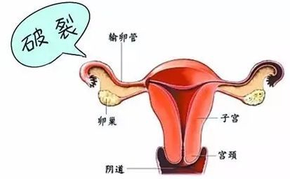 女性发生宫外孕的几率