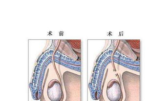 男性结扎完以后会肾虚吗