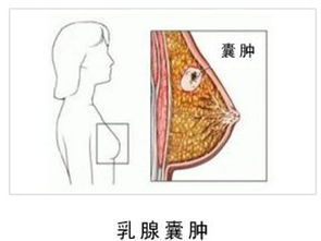 乳腺囊肿会癌变吗:乳腺囊肿不用慌