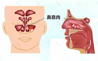 鼻子里面长了个肿瘤，一定要开刀吗？