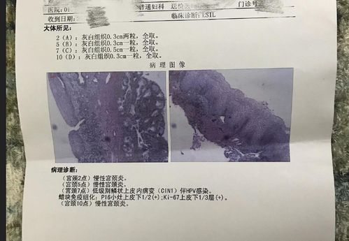 怀孕了宫颈病变怎么办