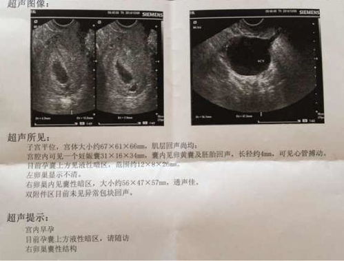 怀孕六周做B超发现孕囊偏左侧宫角，请问这样怎么办